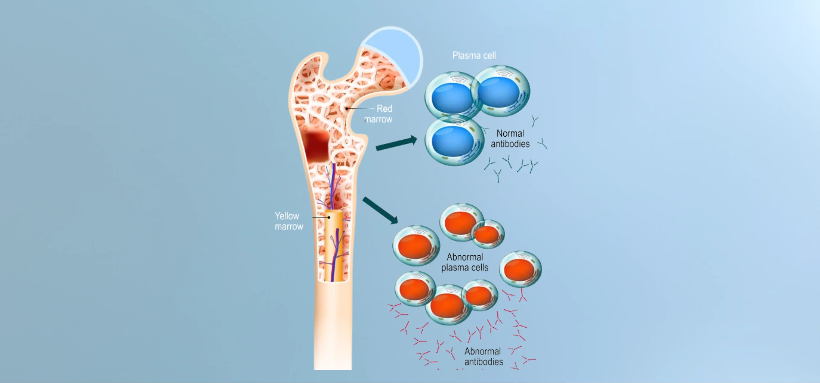 Multiple myeloma treatment by Dr. G. Stitha Pragna in Hyderabad